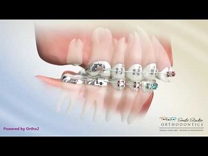 Class II Correction With Second Molar Extraction