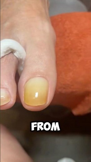 why some people’s nails turn yellow? 💅😱