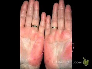 liver 11 (chronic liver disease)