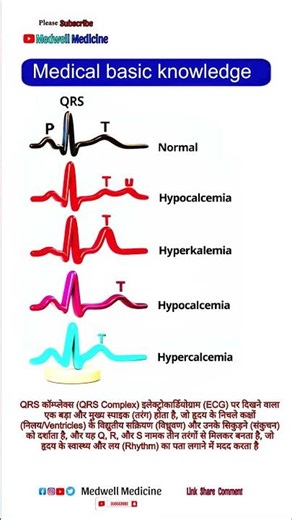 Qrs in hindi | QRS Complex on EKG Strip | How to Interpret EKG Strips | ECG in Hindi | ECG Report