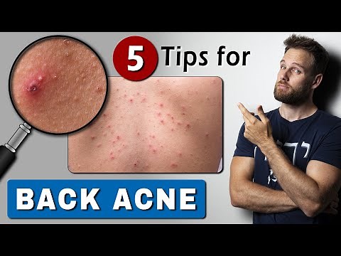 How to GET RID of BACK ACNE fast & easy!