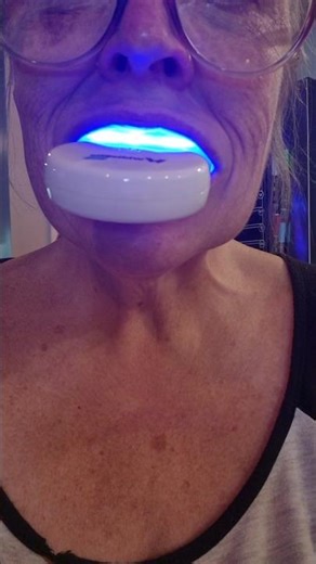 Whitebite Pro Teeth Whitening Kit for Sensitive Teeth.Link in Bio — under BEAUTY Finds #amazonfinds