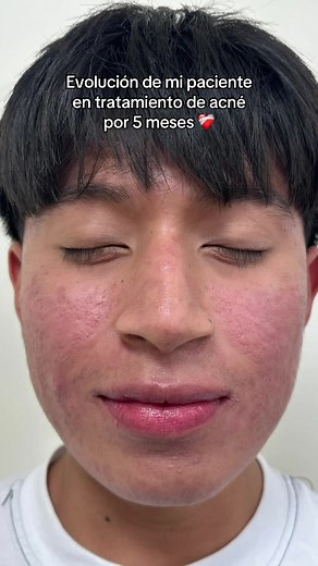 Tratamiento de Acné con Roacutan: Evolución en 5 Meses ❤️‍🩹