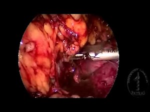 Transvaginal Nephrectomy - Dissection 2 • Video • MEDtube.net