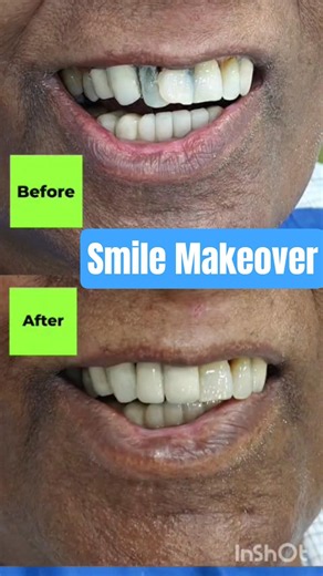 Smile Makeover in Delhi: Get a brand new smile! #smile #delhidentist #dentist