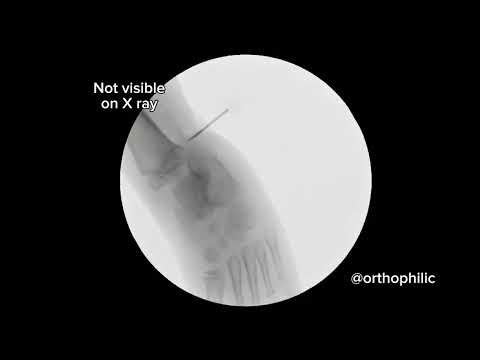 Fibular Hemimelia Reconstruction