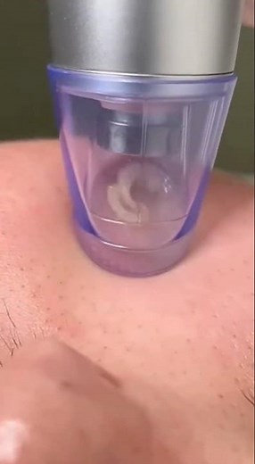 Professional Deep Pore Blackhead Extraction & Cleaning Treatment