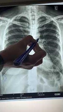 THORAX X-RAY #thorax #thoraxanatomy #radiology #xray #anatomy #mbbs #medicalstudent #ospe #neet