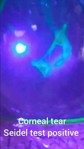corneal tear, Seidel test