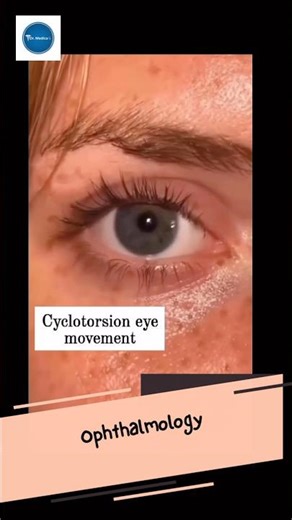 Dr Medica Clinical Cases || Cyclotorsion Eye Movements || Ophthalmology || Clinical Medicine ||