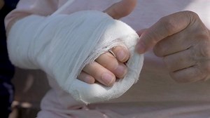 clip-1093986155-arm-compound-fracture-after-surgery-bone-medical