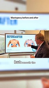 Mastopexy (breast lift) Before and After