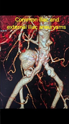 Stent graft placement for iliac artery aneurysms