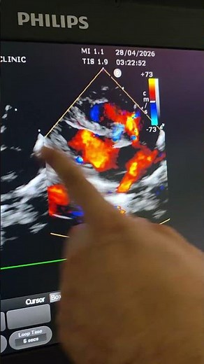 🔴 Subaortic VSD Uncovered | Doppler Flow Insights in Neonates 🫀