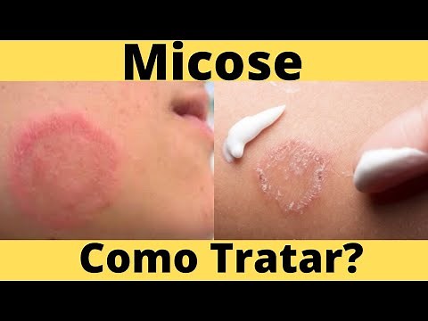 MICOSE DE PELE - Causas e Como Tratar