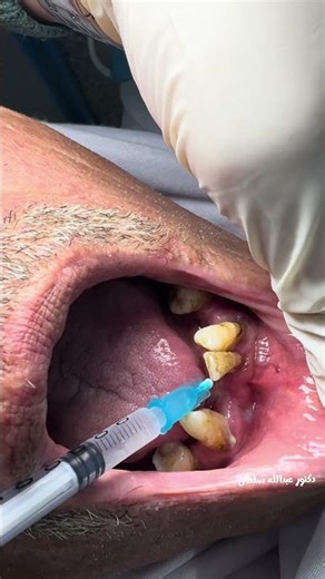 Extraction Forceps For the lower lateral incisor#dr_abdullah_sultan_dentist #extractionteeth