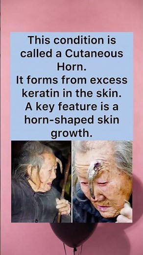 Cutaneous Horn Condition #CutaneousHorn #SkinCondition