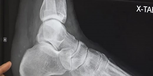 Best Life: Zimmer total ankle replacement