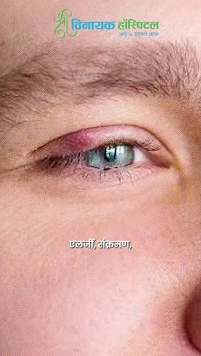 Red Eyes? Don't Ignore These Warning Signs 👁️ #eyecare #raebareli #redeye