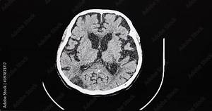 Brain CT cine scan of a patient with diffuse brain atrophy and old cerebral infarction.