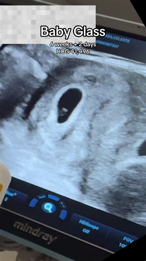 6 Weeks Pregnant: First Trimester Ultrasound Insights