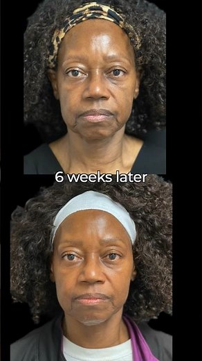 Incredible Sculptra Before & After!