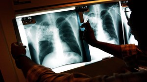 Se registran tres casos activos de tuberculosis en Maine mientras la mortal enfermedad sigue aumentando en todo el país.
