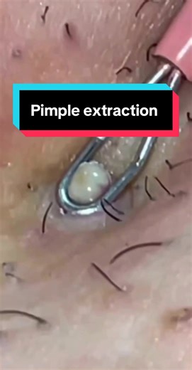 Satisfying comedone pimple pop! #extractions #ingrown #pimple #pimplepopping #pimplepopper