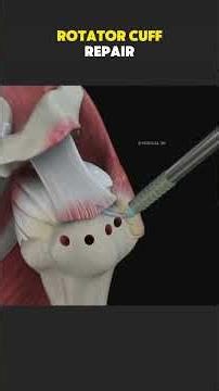 Rotator Cuff Repair Surgery (3D Animation) #shoulderarthroscopy #arthroscopy #rotatorcuff #rotatorcu
