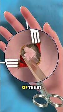 How Trigger Finger Release Surgery Is Performed | Surgical Explanation #TriggerFingerSurgery