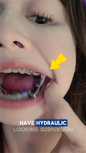 Dental Device That Corrects Overbites Without Surgery