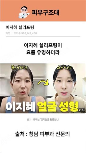 실리프팅 진짜 효과 있을까?ㅣ실리프팅 시술영상, 실리프팅 부작용, 실리프팅 통증, 실리프팅 붓기, 실리프팅 팔자주름, 이지혜 실리프팅, 청담 피부과