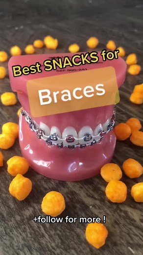 Takis: A Guide to Braces-Friendly Foods