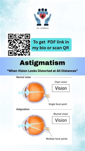 Nazmul on Instagram: "Astigmatism 👁️ When the eye doesn’t focus light at a single point, vision can appear blurred or distorted at all distances. Early detection and proper correction can make a clear difference. 🔍 Scan the QR or check the link in bio for detailed PDF notes. #Astigmatism #EyeHealth #VisionCare #Ophthalmology #nhvitalfacts"