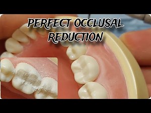 Demo: occlusal reduction for posterior teeth