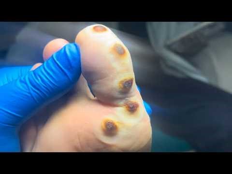 The Soles Of My Feet Are Infected With Fungus And Have Many Warts!【Pedicure Master Lin Jun】