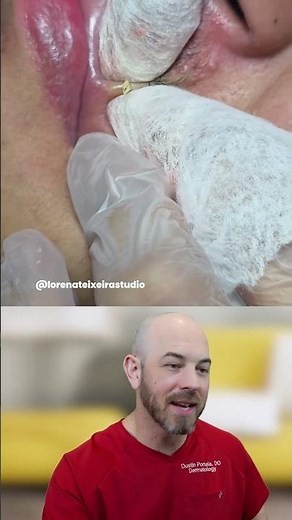 Extraction of Blackheads and Whiteheads Above the Lip