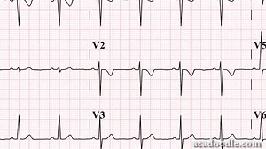 Improve your ECG skills - http://buff.ly/2gIoqeZ | ECG Teacher