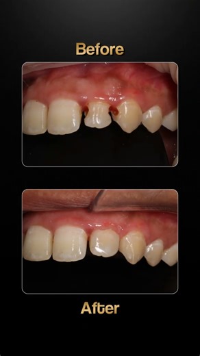 A Subtle Dental Treatment That Restored Her Smile #vedadentistry