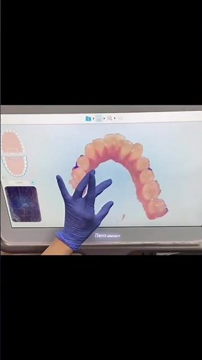 How Invisalign iTero Scanner Works!