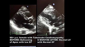 2.1K views · 45 reactions | Takotsubo Cardiomyopathy #CCU_ECHO | CCU | Facebook