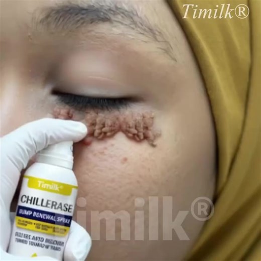 “Too scared to cut it off, and too tired of hiding it.” If you’ve had a mole or skin tag for years, you already know the frustration: • Dermatologists charge $300–$400 for removal • Cutting it off sounds painful • And seeing it in the mirror every day makes you feel worse That’s exactly why ChillErase Clinical Spray was created — a simple, at-home alternative that actually works. “I had a skin tag on my neck for 5 years. I was terrified to get it cut off. I started using ChillErase 10 days ago a