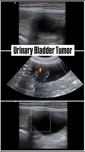 Ehsan Amini | Veterinary Radiologist on Instagram: ". Urinqry Bladder Tumor in a 14 years old medium size mixed breed dog . Common types of urinary bladder wall tumors in dogs include: 1. Transitional Cell Carcinoma (TCC): Most common malignant bladder tumor in dogs. Often arises at the trigone area. Locally invasive and may metastasize. 2. Leiomyoma / Leiomyosarcoma: Tumors of smooth muscle origin. Leiomyomas are benign; leiomyosarcomas are malignant. Less common than TCC. 3. Rhabdomyosarcoma: 