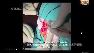 Bilobed Transposition Flaps: Practical Tips for Design & Execution