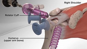 #RotatorCuffRepair with Arthrex #SpeedBridge Instructional Video ___ JOIN OUR COMMUNITY The Operating Room Global (TORG). https://www.operatingroomissues.org/membership-account/membership-levels/ Follow us on Instagram here @operatingroomissues Like our Page on Facebook here https://facebook.com/operatingroomissues ● Newly unveiled TORG Official YouTube. Like | SUBSCRIBE | Share - TORG Online https://www.youtube.com/channel/UCgpnKVlaD2uA9Z5TQJWy4AA ● Join Our Interactive Group on facebook here h