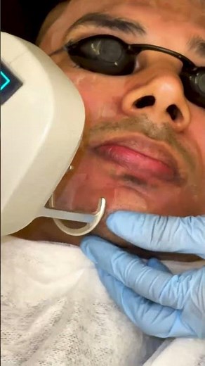 CO2 Laser Treatment | Dark Spots, Scars, and Moles Remove in Single Visit | Dr. Lalit Kasana