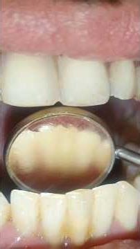 3 yıllık fiber splint ve ölü diş splint kontrol videosu