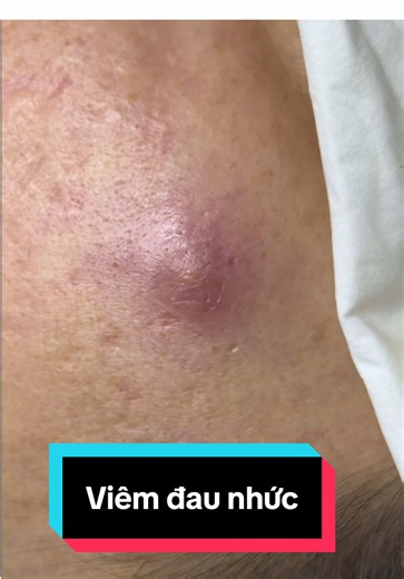 BaBo #nặnmụnbằngtay #TikTokAwardsVN #mụnchai #mụnviêm #nặnmụnquận12 hân hạnh được phục vụ anh chị❤️