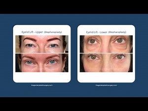 Blepharoplasty 101: Upper & Lower Eyelid Surgery Explained by a Top Surgeon! (Before & After)