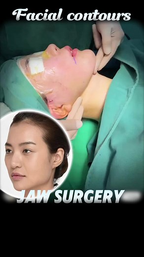 Jaw surgery, 3D animation demonstration#surgery #faceshape #jaw #jawline #mandibular